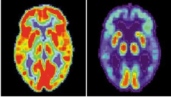 Alzheimer’s can now be detected with just one MRI scan